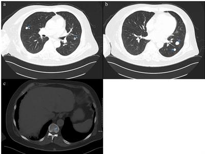 Case Report: Safety and Efficacy of Enfortumab Vedotin in a Patient With Metastatic Urothelial Carcinoma Undergoing Peritoneal Dialysis 